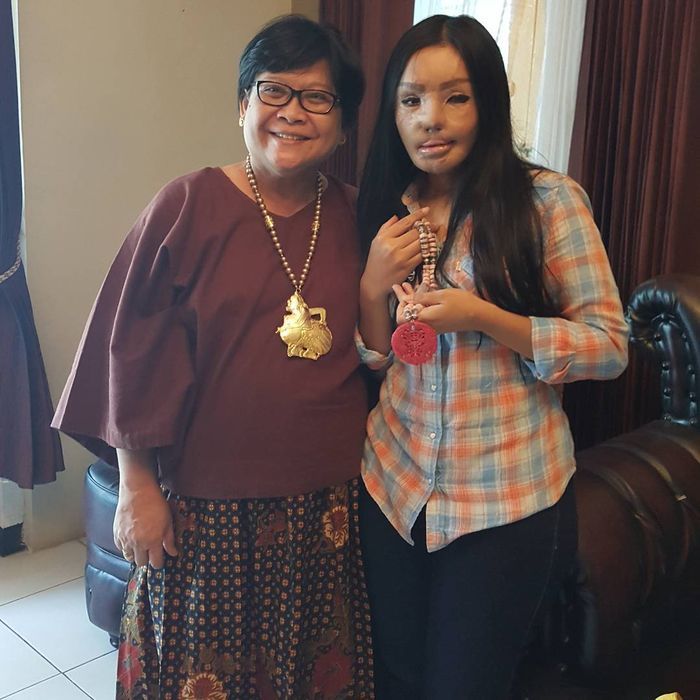 Sempat Hilang, Kini Kabar Lisa Face Off yang Disiram Air Keras Kembali Mencuak