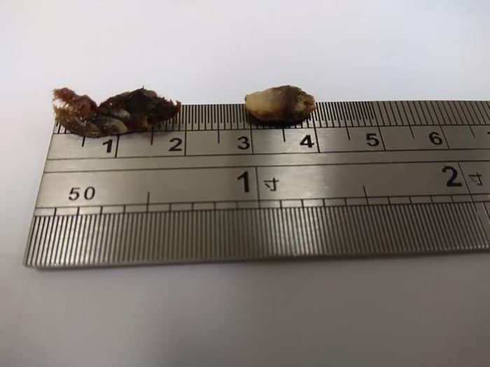 Kotoran yang berhasil dikeluarkan dari telinga balita ini sepanjang 2 centimeter.