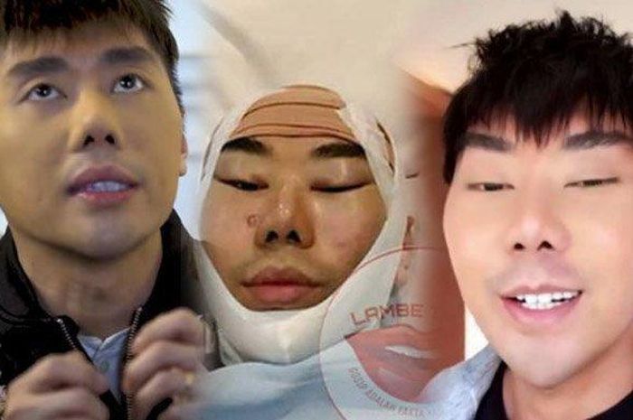 Roy Kiyoshi Operasi Plastik