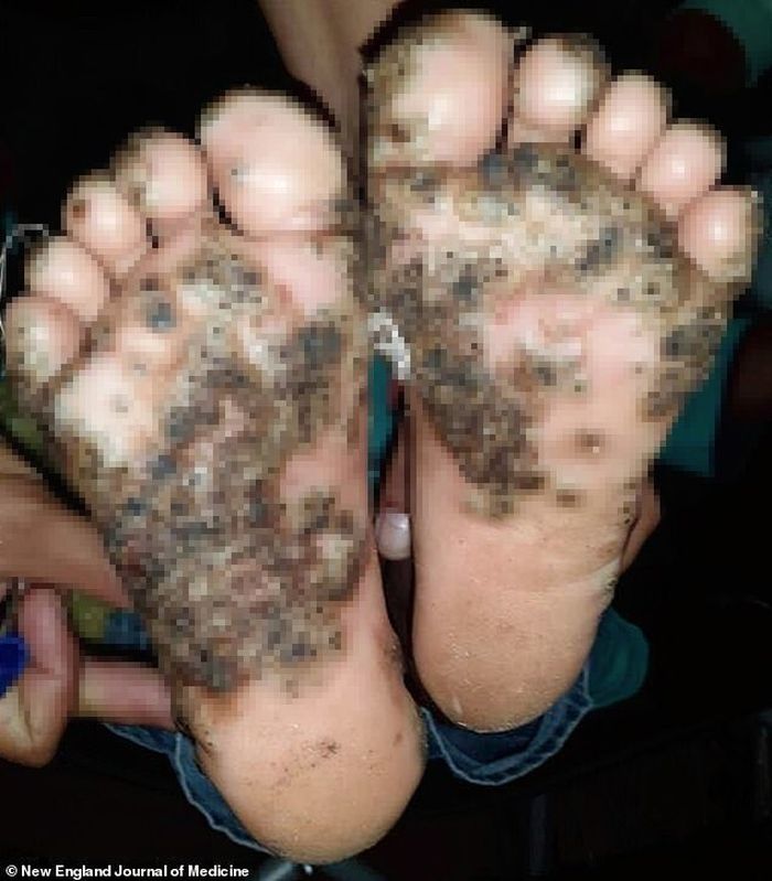 Kondisi kaki gadis 10 tahun, kakinya membusuk karena kutu penghisap darah pasca bermain-main di kandang babi. 