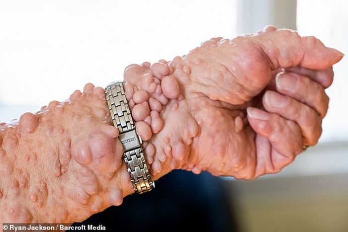 Kelainan Neurofibromatosis