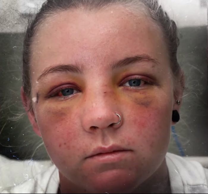 Wajah Elisha Greer babak belur akibat disiksa Martin