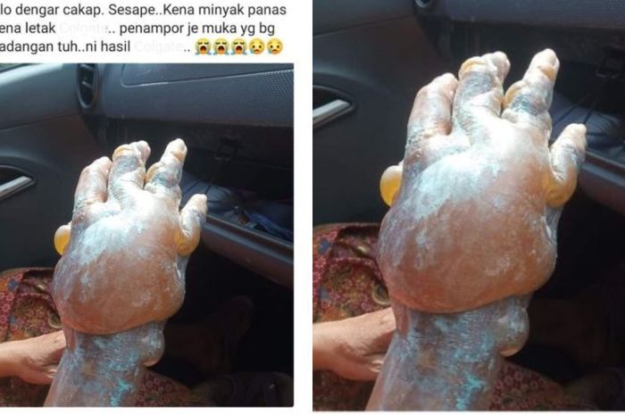 Peringatan seorang mengalami luka bakar menggunakan pasta gigi.