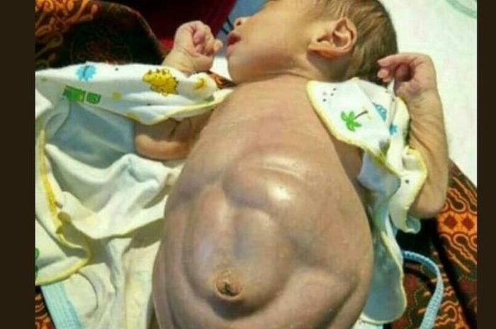 Perut bayi 4 bulan membesar setelah diberi makan nasi