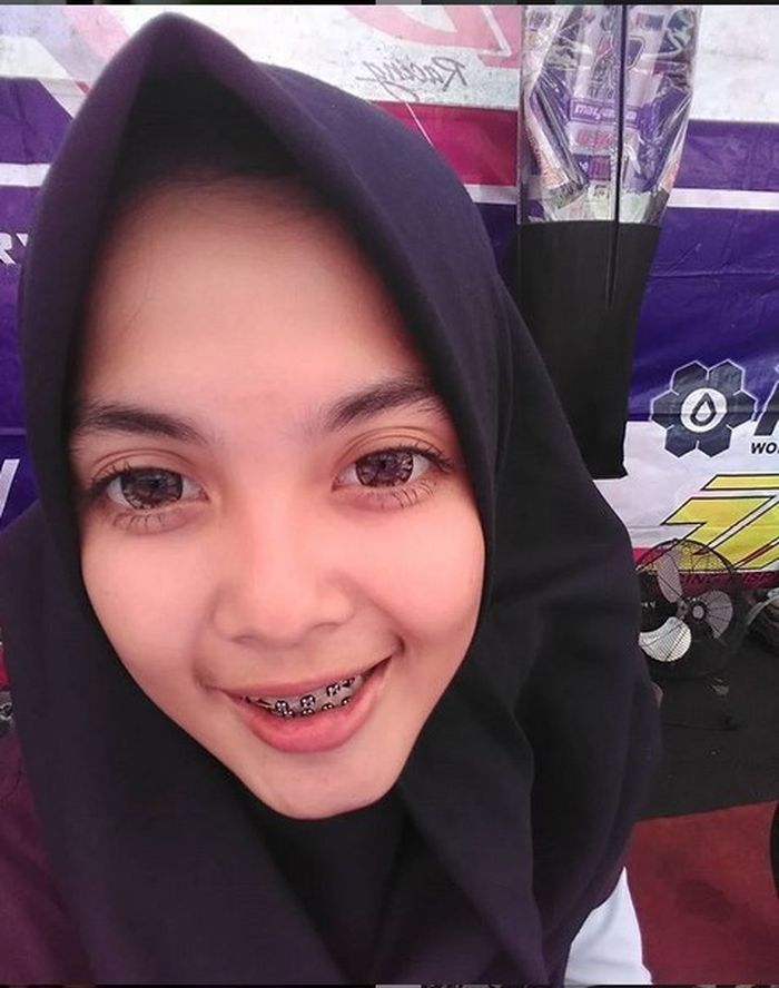 Kintan Mary saat masih menggunakan behel gigi yang membuat giginya terkena kanker.