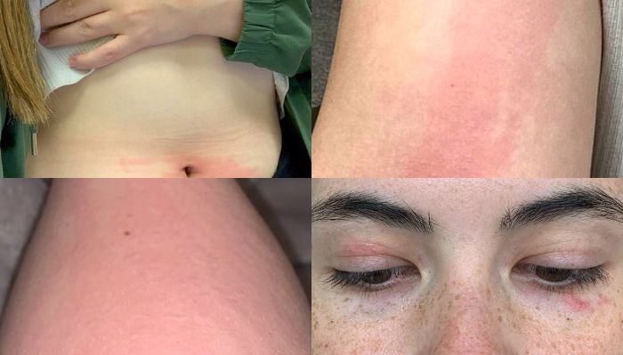  Ruam kulit yang diderita Tessa saat terkena air.