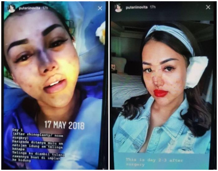 Operasi Plastik yang dilakukan PNR