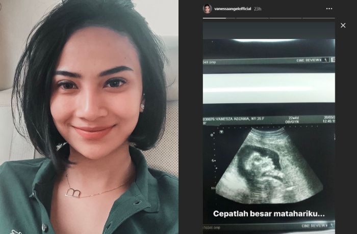  Gambar hasil USG kandungan Vanessa Angel.