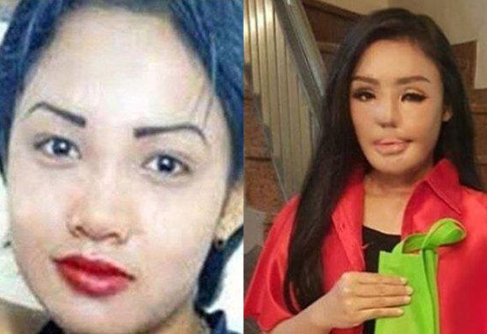 Contoh kasus penyiraman air keras. Foto sebelum dan sesudah Lisa tersiram air keras dan menjalani rangkaian operasi agar wajahnya lebih baik.