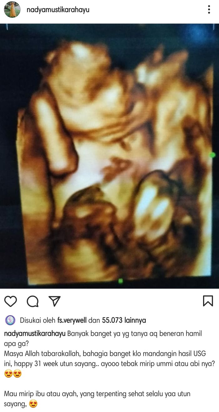 Nadya Mustika Rahayu mengunggah foto USG yang memperlihatkan bentuk janin usia 31 minggu dalam kandungan di akun Instagramnya.