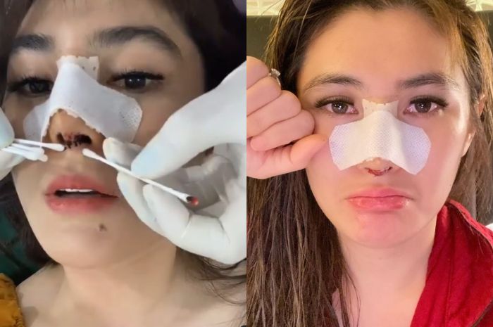 Angela Lee setelah lakukan operasi hidung dari endorse