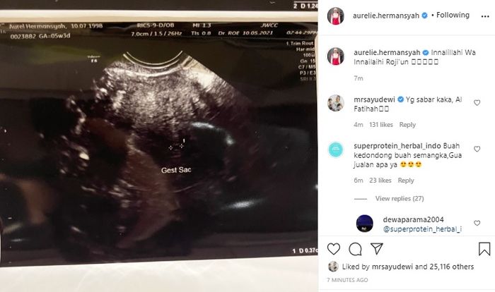 Aurel Hermansyah mengumumkan bahwa dirinya mengalami keguguran. 