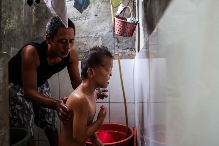 Azmi Ramadan, bocah berusia 5 tahun yang memiliki kondisi tubuh yang sangat memprihatinkan.