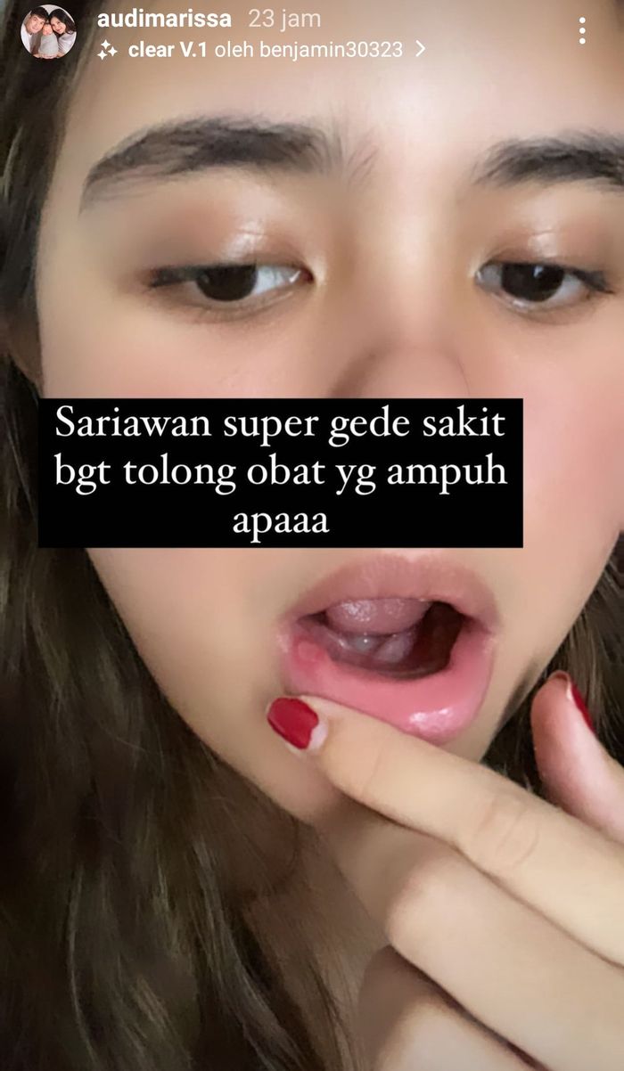 Unggahan Audi Marissa saat menjelaskan dirinya alami sariawan yang cukup besar.