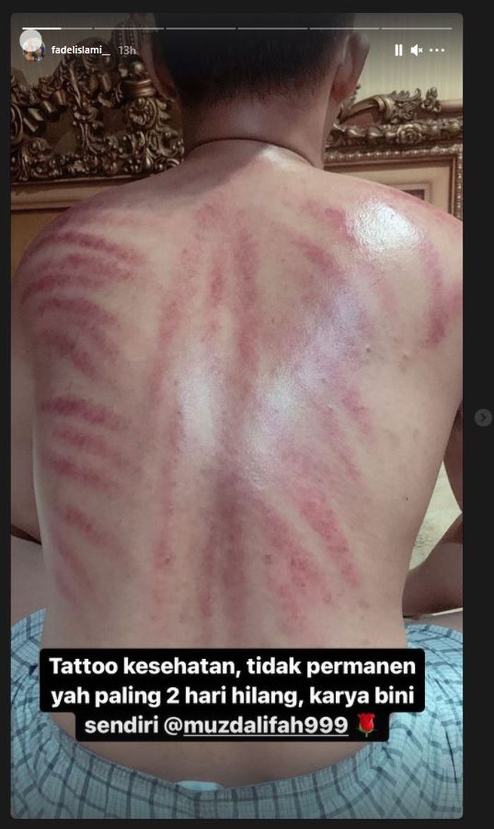 Fadel Islami terang-terangan pamerkan punggung merah penuh bekas kerokan