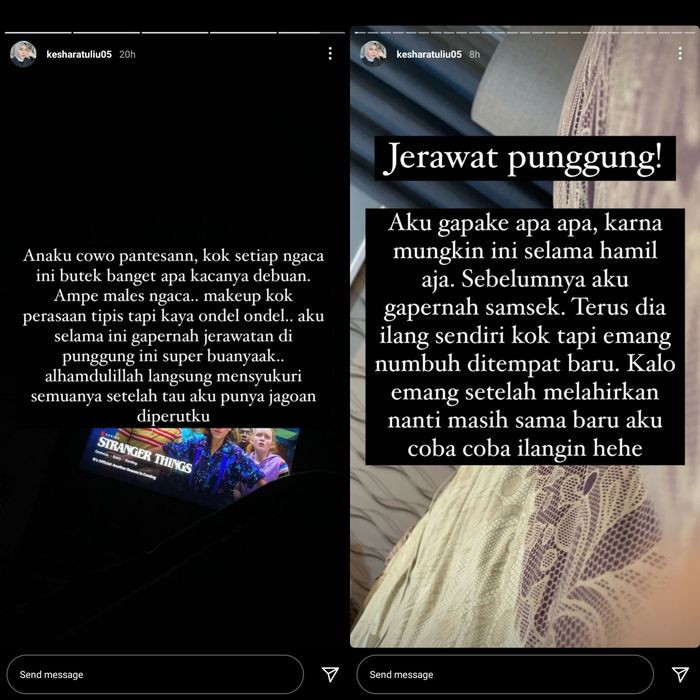 Unggahan Kesha Ratuliu yang menderita jerawat punggung saat hamil.