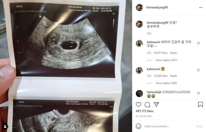 Kakak Jin BTS unggah foto USG sang istri