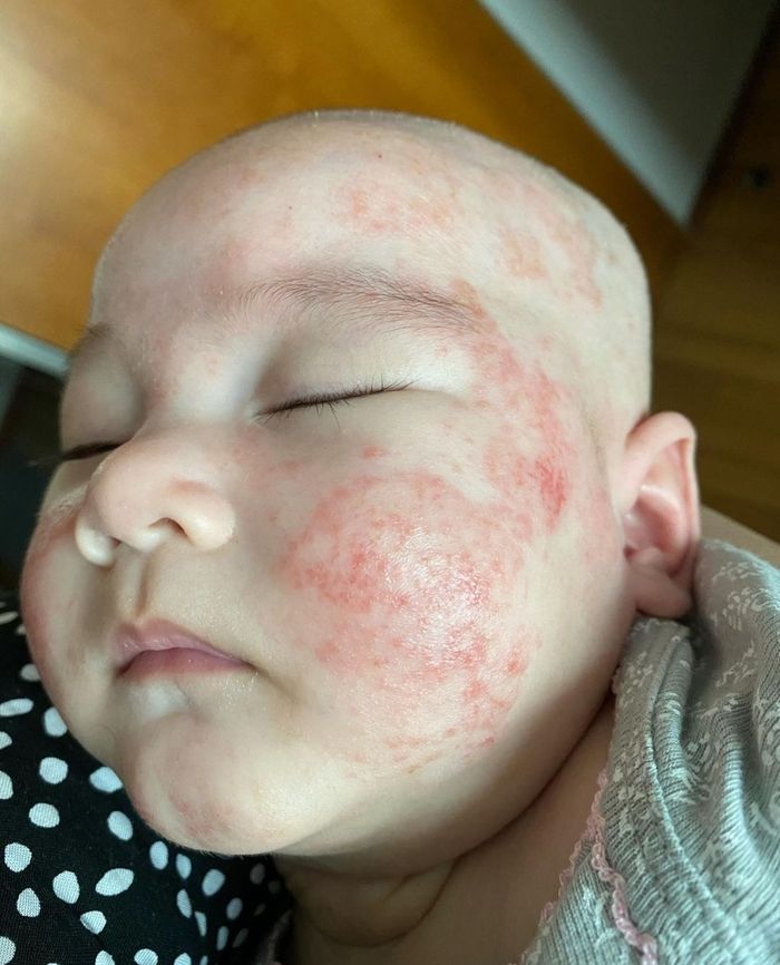 Potret Numa mengalami eksim.