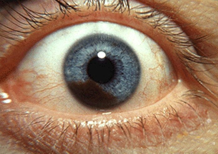 Tumor uveal dapat berasal dari melanosit yang berada di dalam iris. Jika ia menunjukkan tanda-tanda keganasan, mereka akan diklasifikasikan sebagai iris melanoma.
