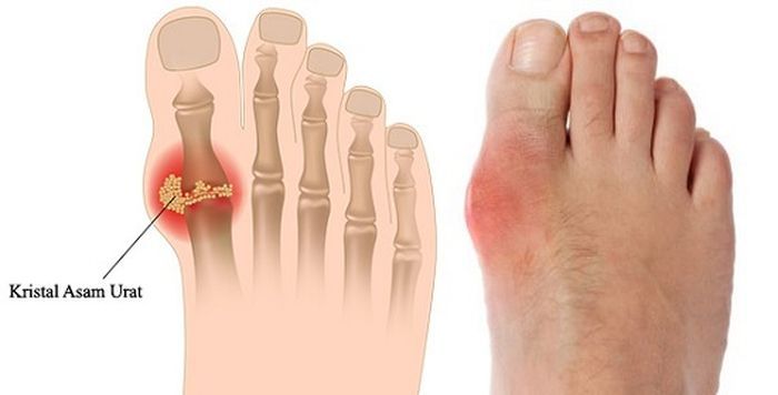 Asam Urat