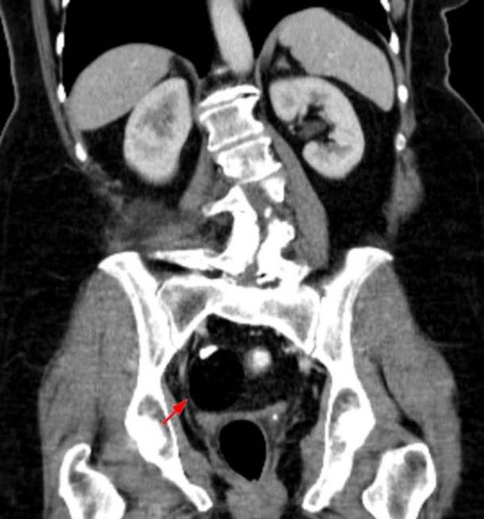 CT scan menunjukkan teratoma ovariumi.
