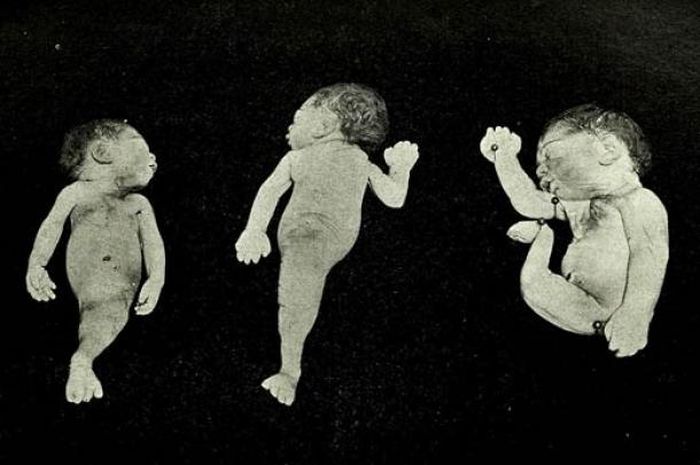Gambar kasus klinis sirenomelia, atau Sindrom Putri Duyung, dilaporkan dalam Maryland Medical Journal edisi 1902.