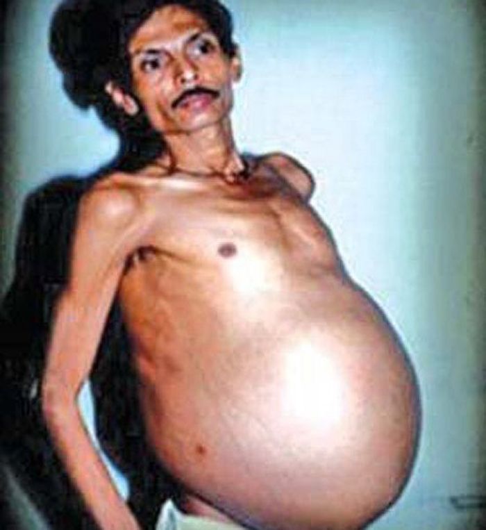 Foto Sanju Baghat pada tahun 1999 sebelum operasi.