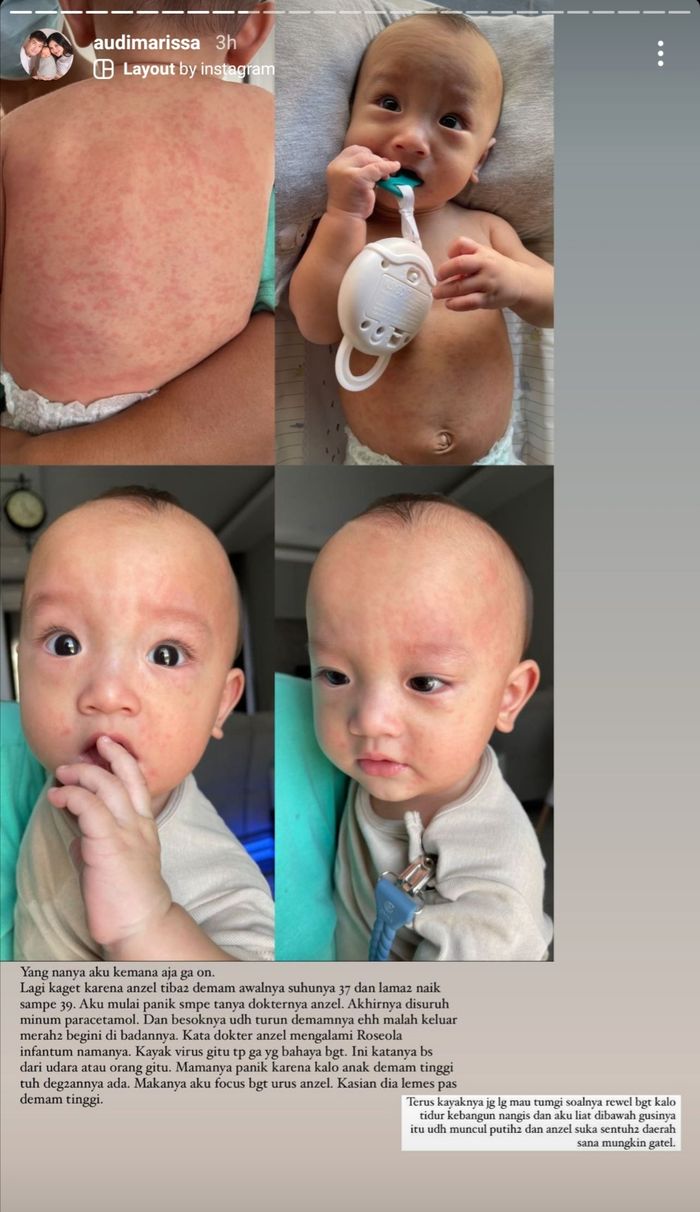 Unggahan Audi Marissa yang menceritakan infeksi virus roseola infantum yang diderita anak pertamanya.