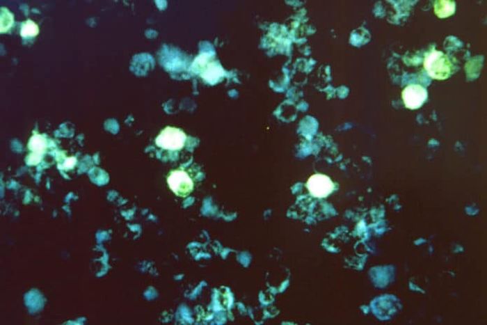 Sel yang terinfeksi Epstein-Barr, virus herpes umum yang dapat menyebabkan mononukleosis dan menyebabkan infeksi inang yang laten seumur hidup. 