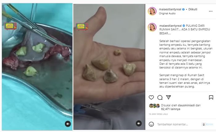Penampakan batu empedu yang baru diambil dari tubuh Maia Estianty.