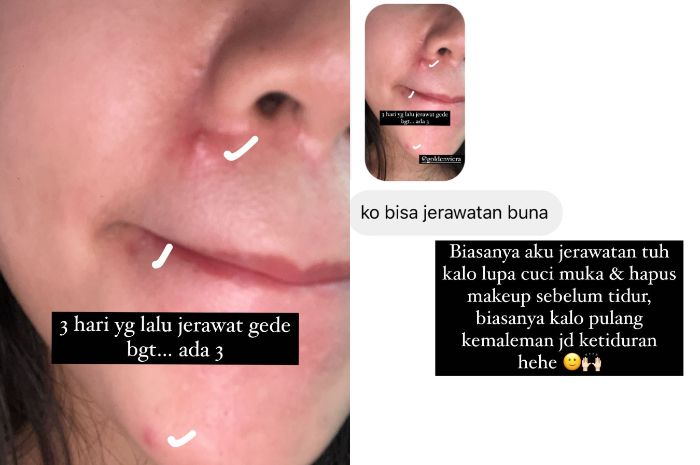 Rachel Vennya dengan kondisi wajah berjerawat
