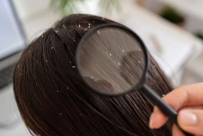 Jadi masalah yang paling sering dialami masyarakat Indonesia, yuk kenali cara mengatasi ketombe.