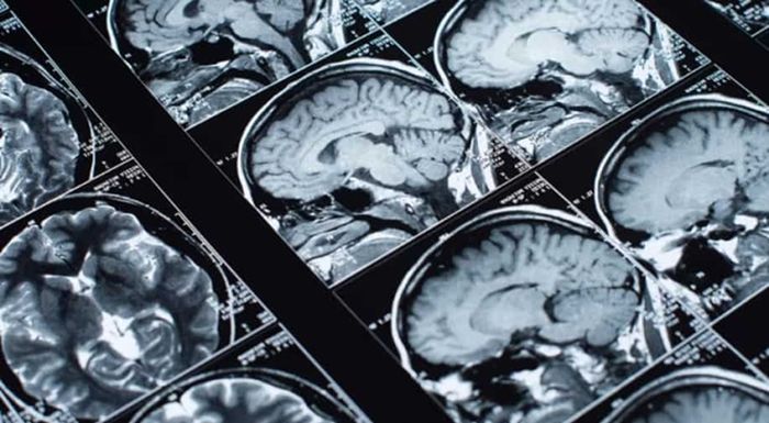 Ilustrasi gambar hasil pemindaian MRI (magnetic resonance imaging) yang dapat melihat otak.