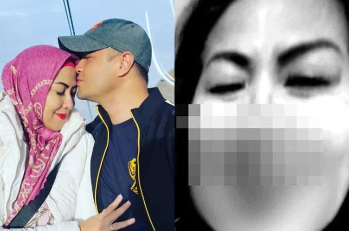 Geger foto hidung berdarah Venna Melinda diduga setelah alami KDRT Ferry Irawan
