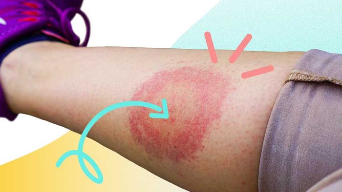 Penyakit Lyme atau Lyme disease adalah penyakit akibat infeksi bakteri yang ditularkan melalui gigitan kutu.