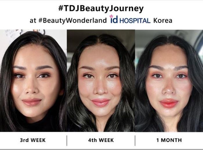 Perubahan wajah Titi DJ pasca operasi plastik