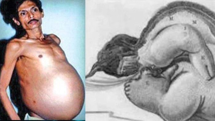 Pria 'hamil' di India, 36 tahun mengandung saudara kembarnya sendiri.   