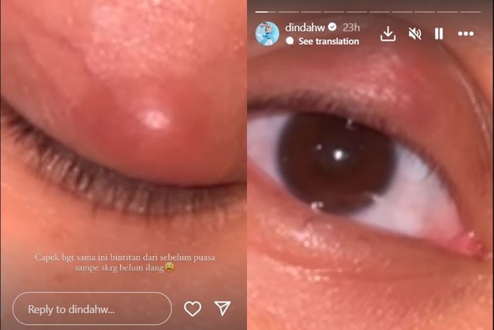 Dinda Hauw alami benjolan merah pada mata