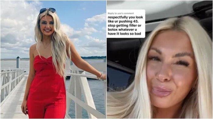 Niatnya Pengen Punya Wajah Kinclong, Selebgram 22 Tahun Ini Malah Menjelma Jadi Tante-tante Gegara Botox