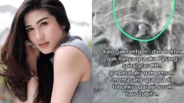 Hasil rontgen Stevie Agnecya yang sempat viral