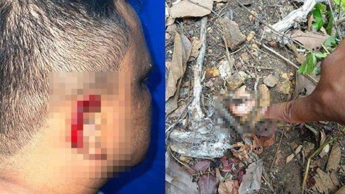 Muhammad Yudhi (36) korban penganiayan penagih utang, 2 telingah ditebas sampai putus