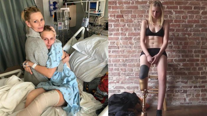 Kaki model ini diamputasi gegara pembalut atau tampon