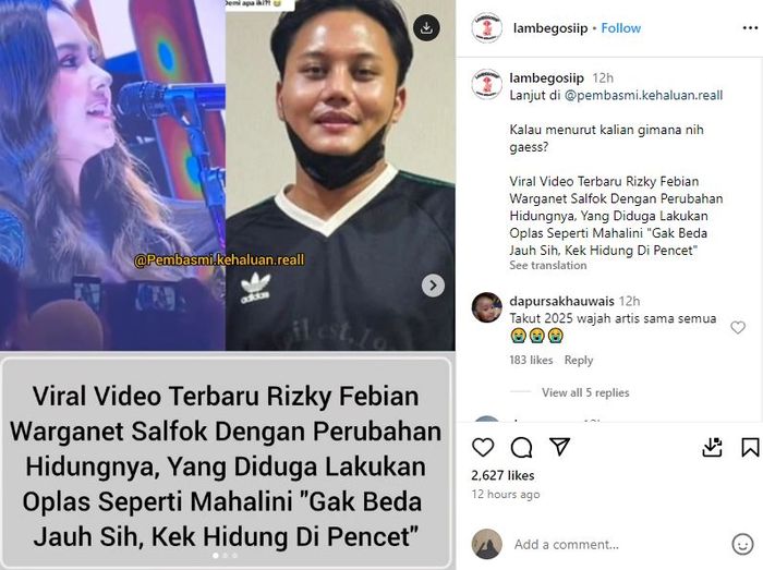 Rizky Febian ikut lakukan operasi plastik seperti Mahalini