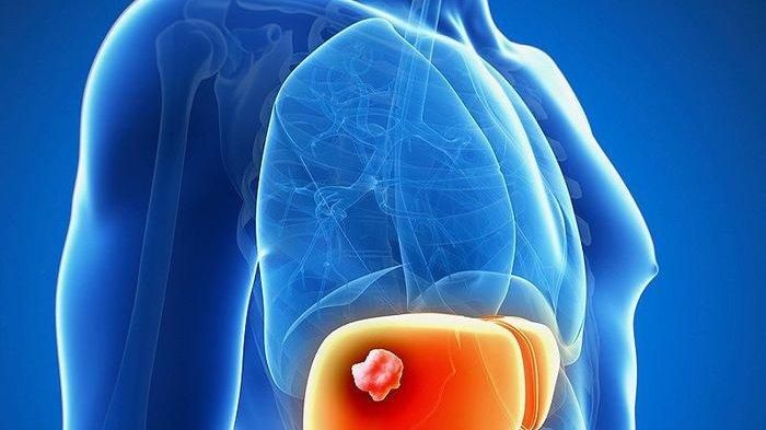 Ilustrasi abses hati yang diderita Hotman Paris