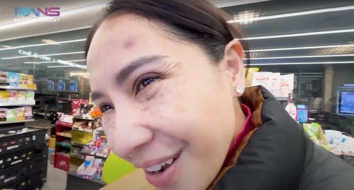 Kondisi wajah Nagita Slavina setelah melakukan treatment kulit di Korea Selatan.