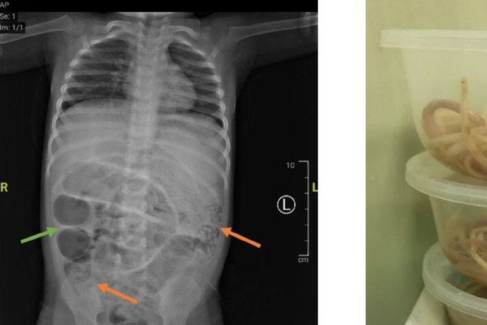 Perut anak di Jember yang dipenuhi hewan ini hingga tak bisa BAB selama seminggu. Ia lalu dibawa ke RSD dr Soebandi. 