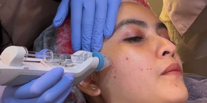 Injeksi bahan aktif saat treatmen skin booster.