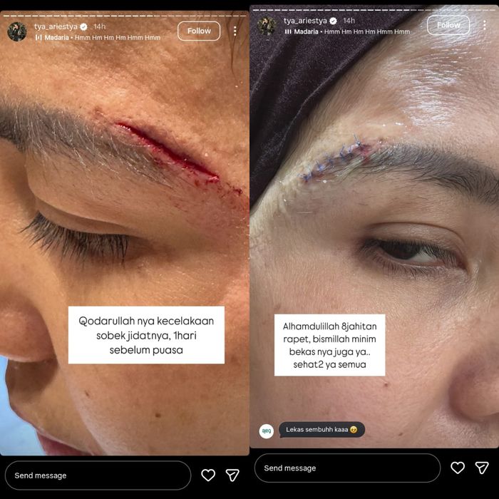 Tya Ariestya mengalami kecelakaan hingga bagian dahinya robek satu hari sebelum Ramadan. 