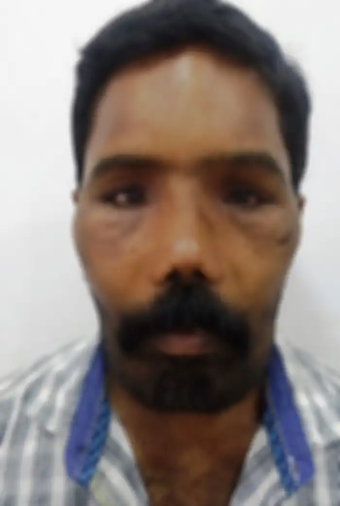 Suresh setelah dioperasi