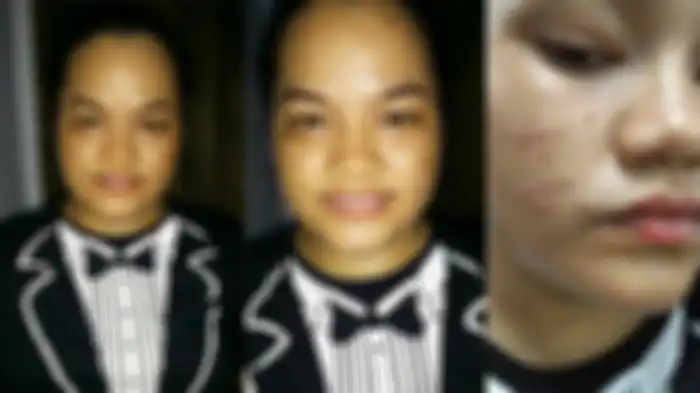 Wajah Junita berjerawat